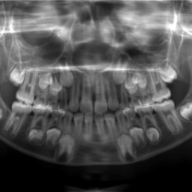 Máy X-quang nha khoa Pano IC5 HD Ảnh toàn cảnh răng trẻ em với liều tia thấ