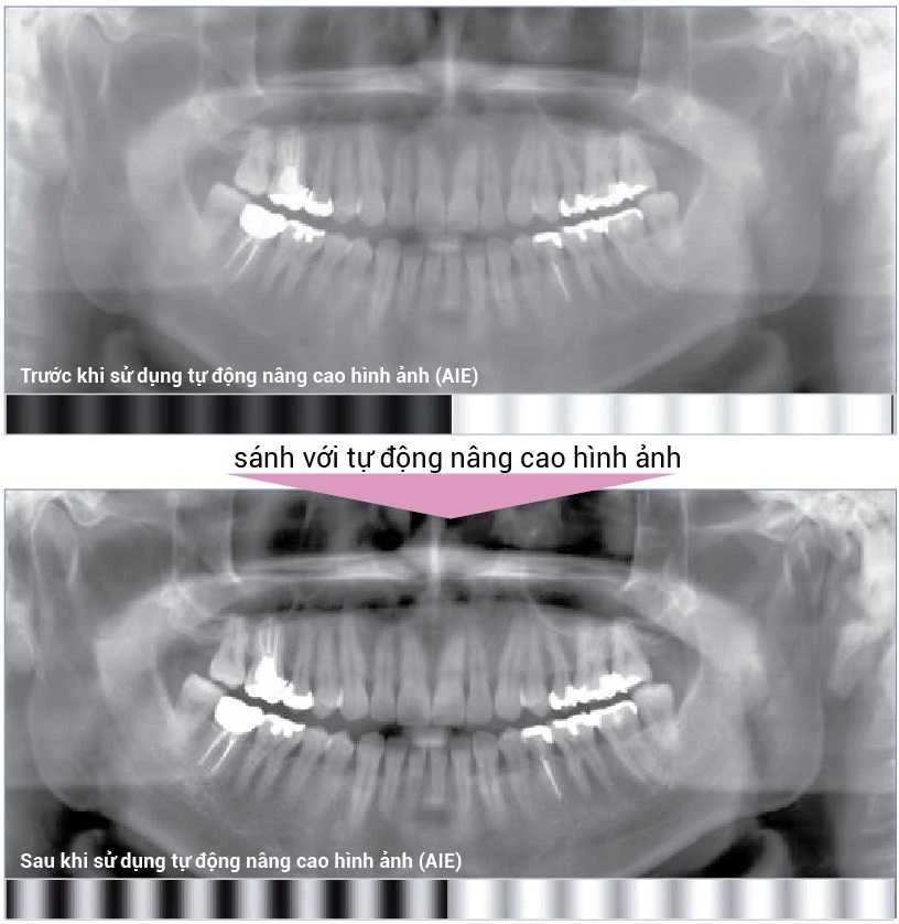 Máy X-quang nha khoa Pano IC5 HD hình ảnh tự động (AIE) so sánh