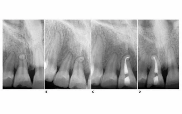 Phim X-quang điều trị của răng cửa giữa hàm trên bên phải