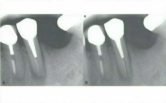 điều trị nội nha - nứt dọc chân răng