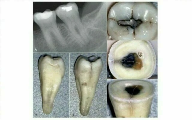 điều trị nội nha - nứt dọc chân răng