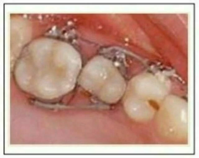  Sử dụng cleat ở mặt trong của răng
