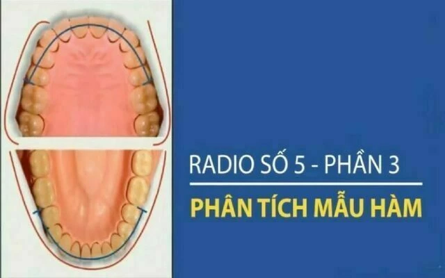 phân tích răng hỗn hợp moyer
