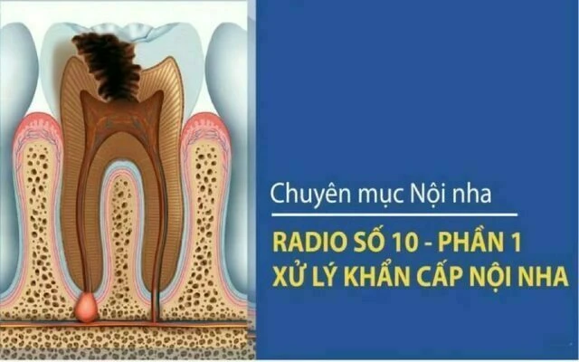 xử lý khẩn cấp nội nha