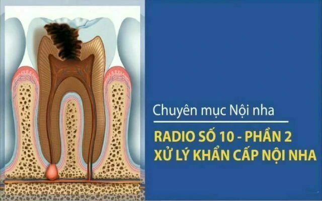 xử lý khẩn cấp nội nha