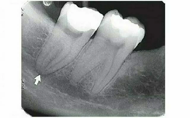 chân răng