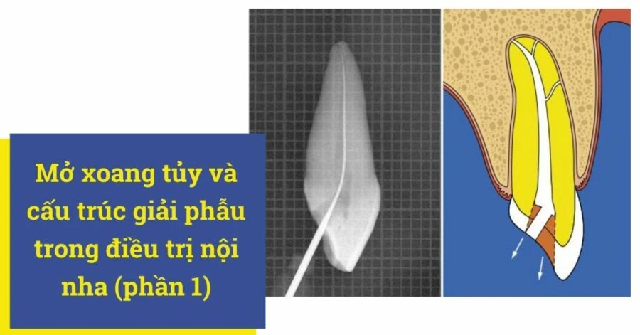 Mở xoang tủy và cấu trúc giải phẫu trong điều trị nội nha (phần 1)