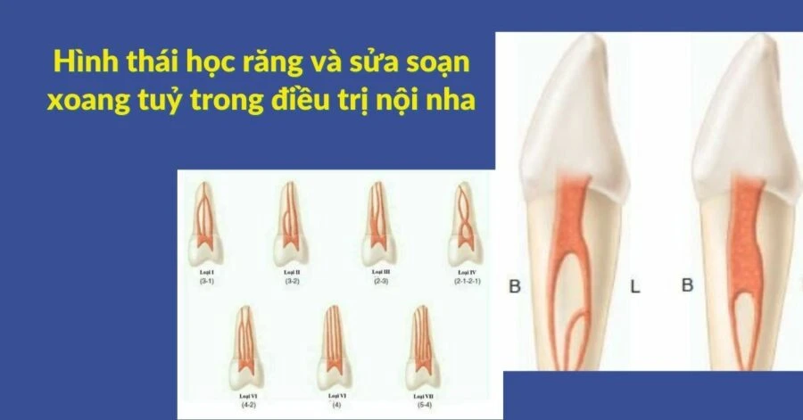 Hình thái học răng và sửa soạn xoang tuỷ trong điều trị nội nha