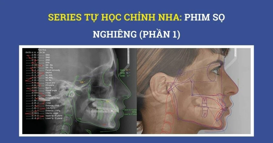 Series tự học chỉnh nha: phim sọ nghiêng (phần 2)