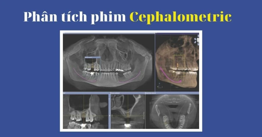 Phân tích phim Cephalometric