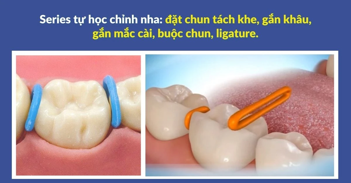 Series tự học chỉnh nha: đặt chun tách khe, gắn khâu, gắn mắc cài, buộc chun, ligature.