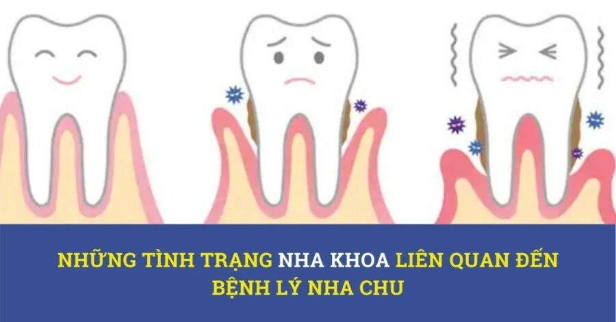 Những tình trạng nha khoa liên quan đến bệnh lý nha chu – phần 1