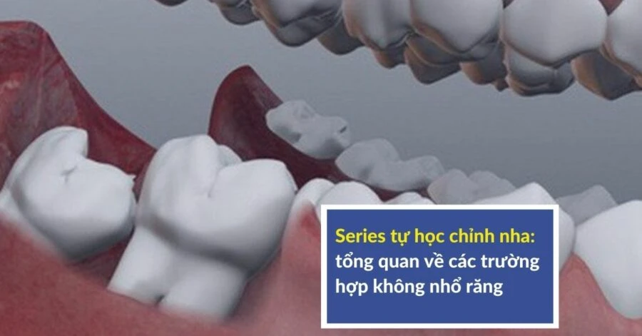 Series tự học chỉnh nha: tổng quan về các trường hợp không nhổ răng – lý thuyết