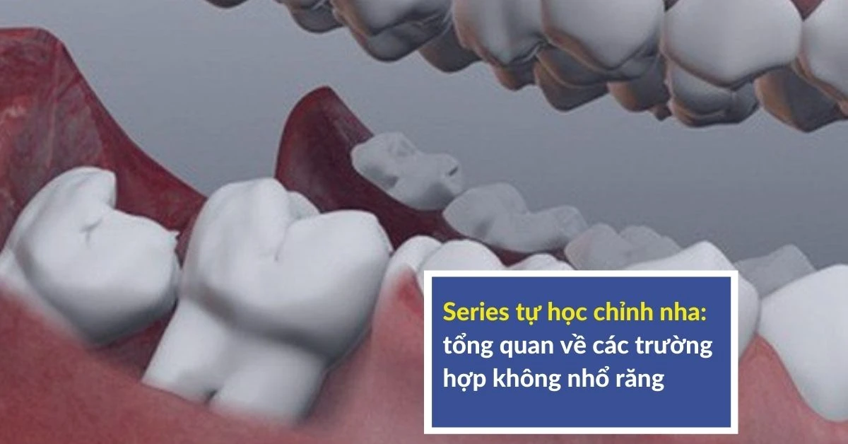 Series tự học chỉnh nha: tổng quan về các trường hợp không nhổ răng – lý thuyết