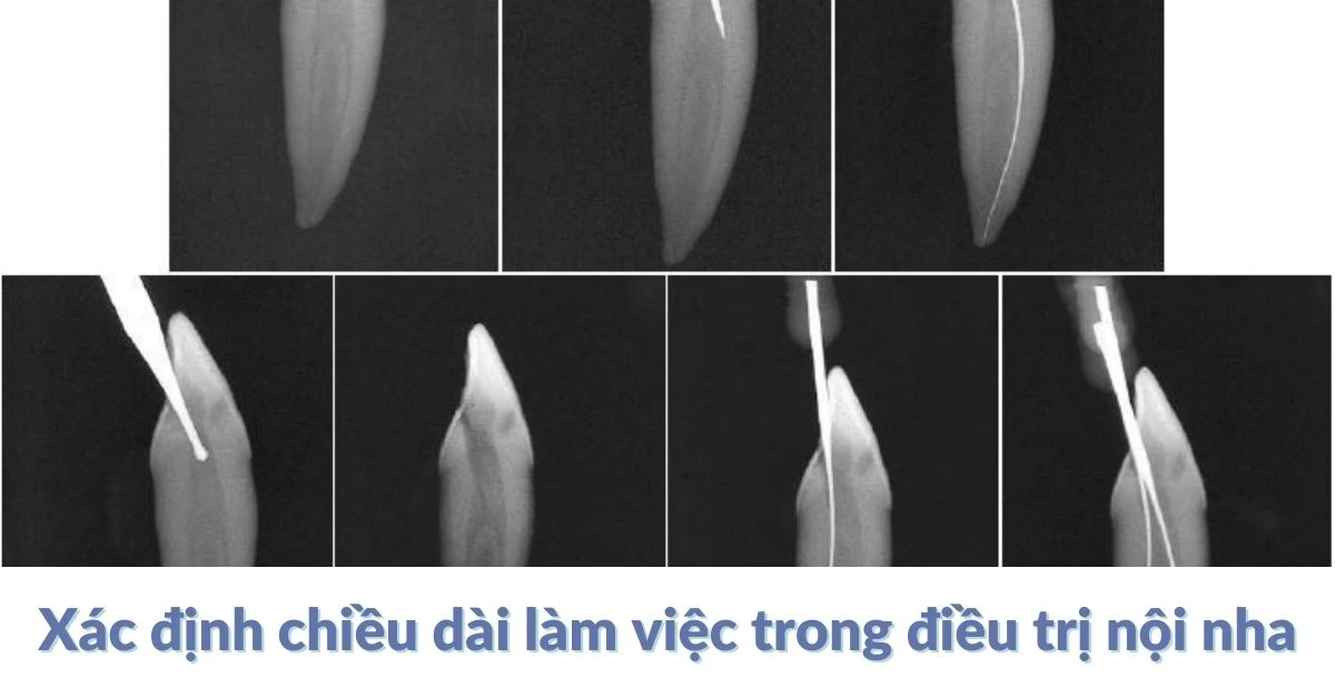 Xác định chiều dài làm việc trong điều trị nội nha