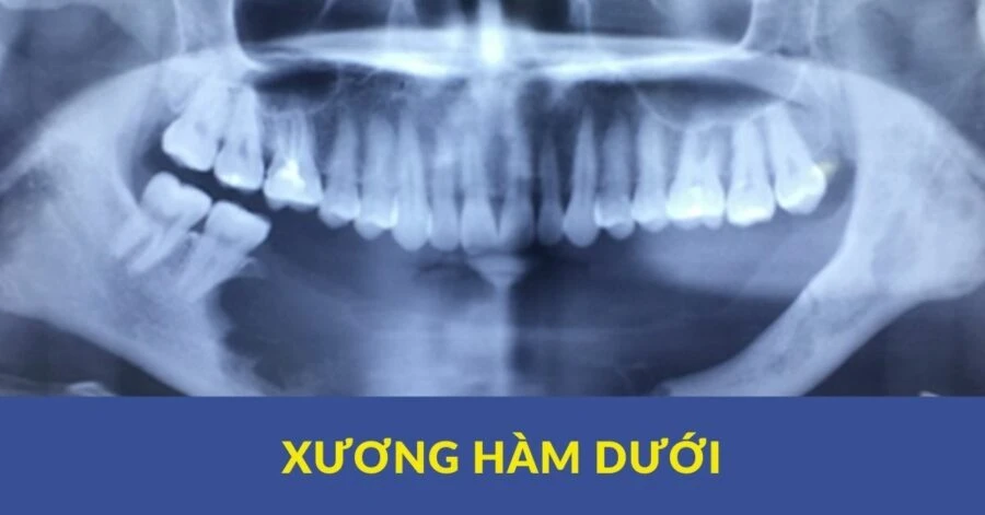 Xương hàm dưới – giải phẫu (phần 1)