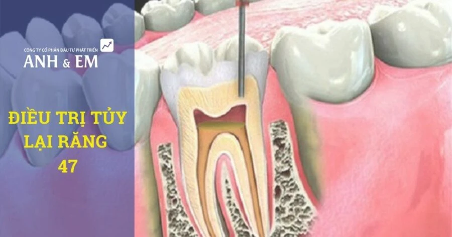 Điều trị tủy lại răng 47 – ca lâm sàng thực tế