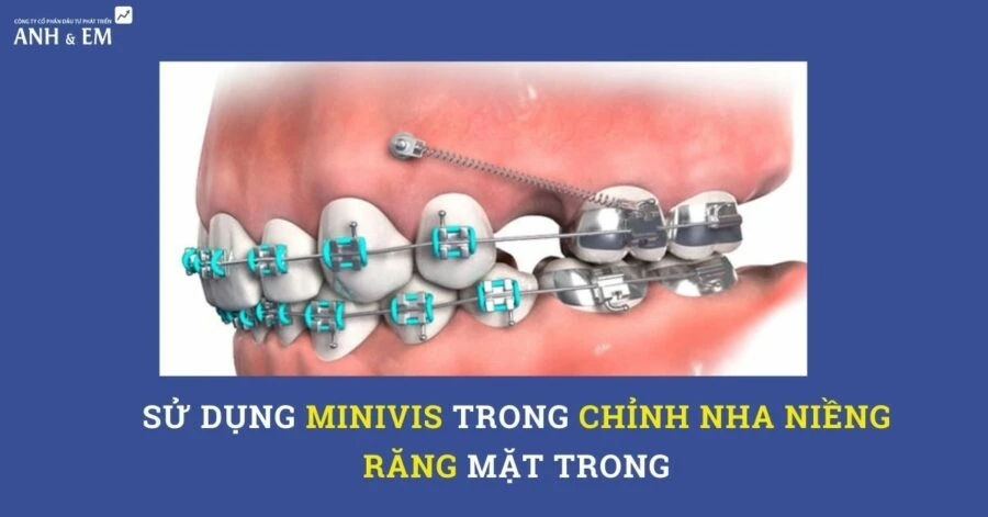 Sử dụng minivis trong chỉnh nha niềng răng mặt trong