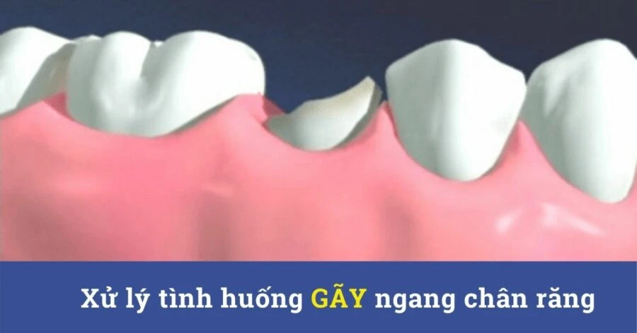 Xử lý tình huống gãy ngang chân răng – cấp cứu