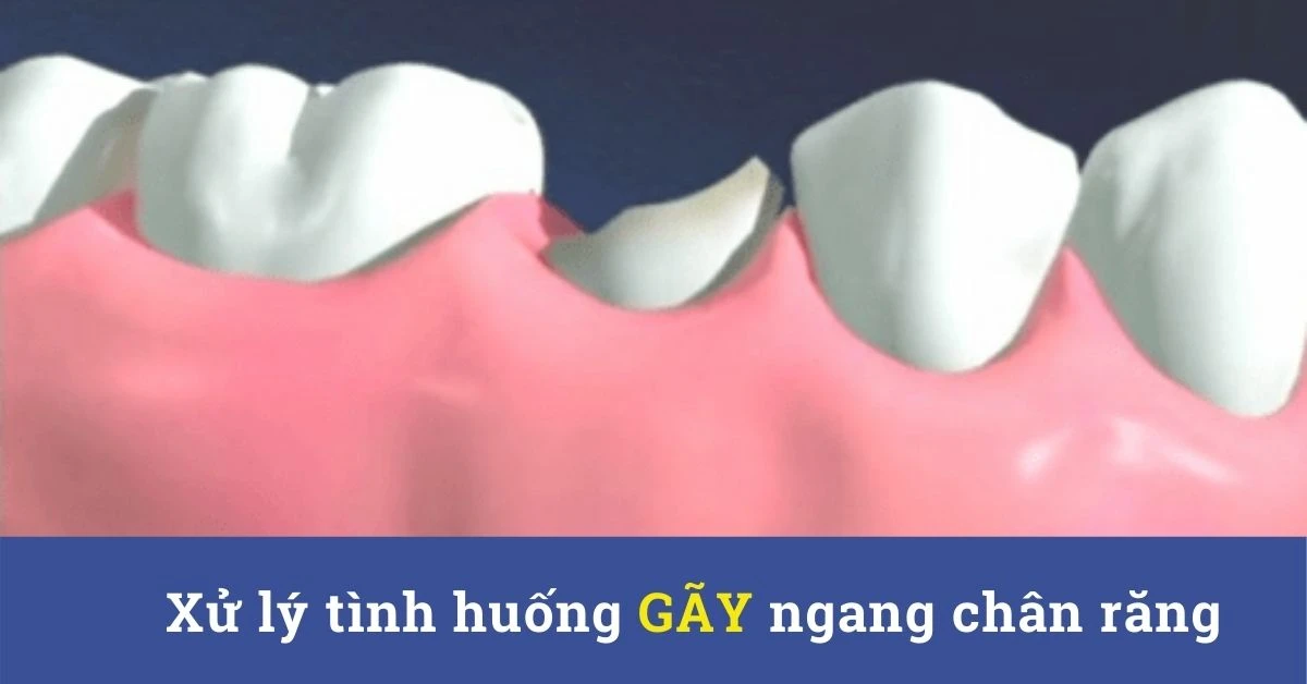 Xử lý tình huống gãy ngang chân răng – cấp cứu