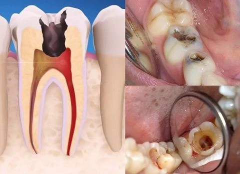 hình ảnh viêm tủy răng