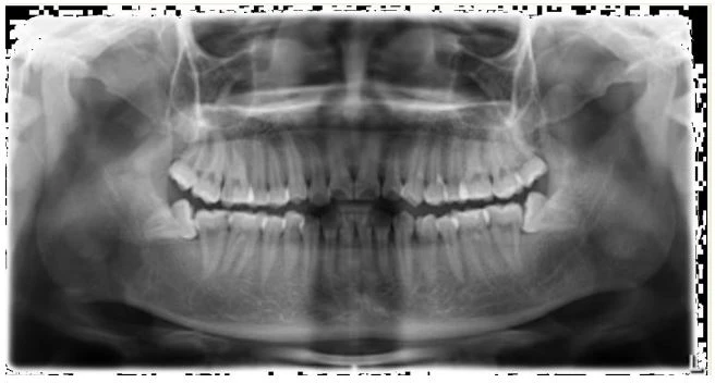 Dùng phim Panorama để kiểm tra mức độ lành mạnh của mô nha chu của những răng sẽ được sử dụng để tăng neo chặn.