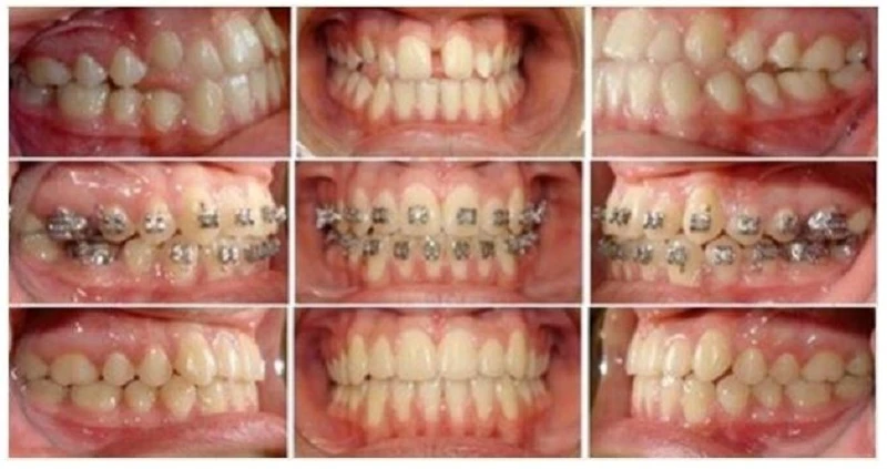 SERIES TỰ HỌC CHỈNH NHA: TRÌNH TỰ DÂY CUNG CHUẨN quá trình mẫu răng