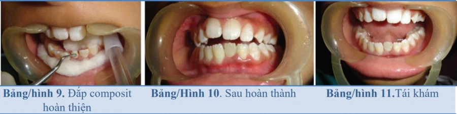 Composit tăng cường sợi: vật liệu chốt và cùi trong răng trẻ em