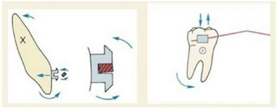 Series tự học chỉnh nha: lực trong chỉnh nha – cơ bản