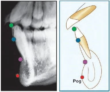 điểm thấp nhất nằm trên đường ráp nối giữa hai phần xương hàm dưới tại vùng cằm.