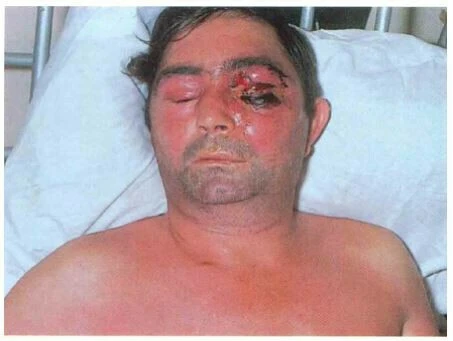 Viêm nhiễm phần mềm vùng miệng – hàm mặt (phần 1)