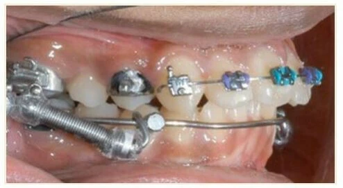 neo chặn răng cối ở vị trí xa trong (Toe-in) hoặc gần ngoài (Toeout)