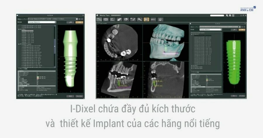 Thiết kế và kích thước Implant nha khoa nổi tiếng