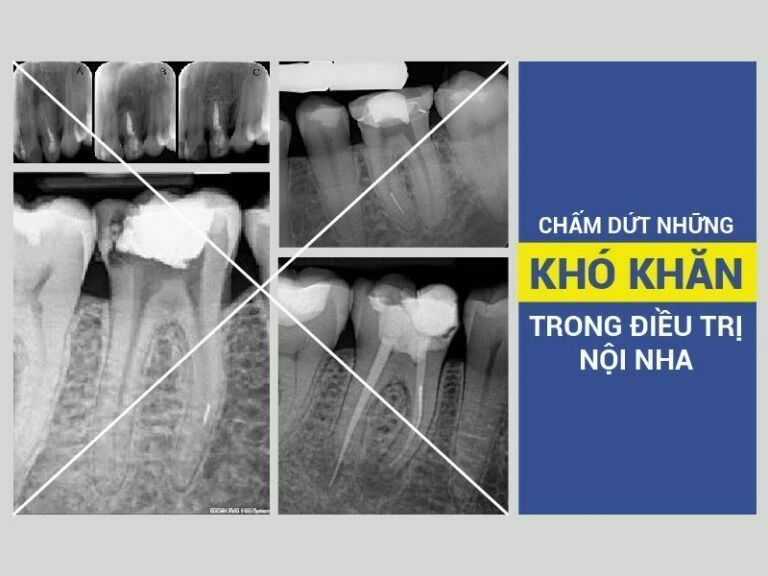 cham_dut_nhung_kho_khan_trong_dieu_tri_noi_nha_0