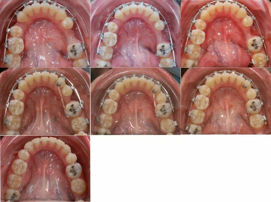 Sửa chữa vẩu hai hàm và đóng khoảng nhổ răng hàm nhỏ – kỹ thuật