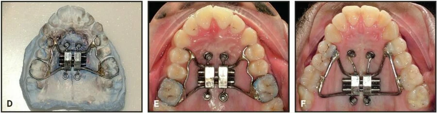 Chế tạo hàm nong nhanh hỗ trợ minivis: kỹ thuật đơn giản cho nha sĩ