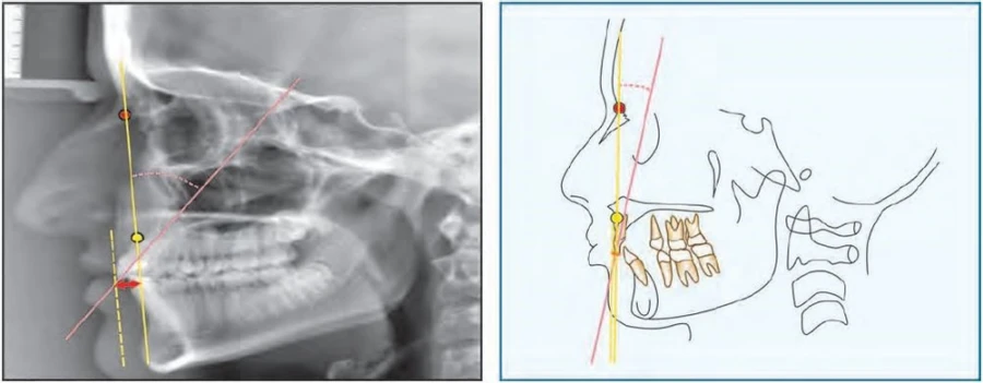 Chỉnh nha ( phần 9) – phân tích Steiner