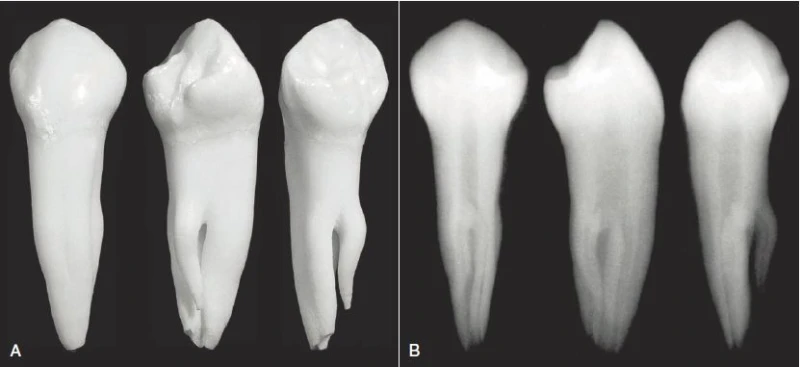 Các răng cối nhỏ (hình 7-9) là một ví dụ hay về giải phẫu hệ thống ống tủy phức tạp