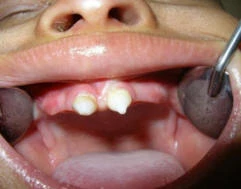 rối loạn mọc răng