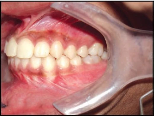 (Chen chúc, xoay hoặc răng ăn khớp sai có thể hiện diện ở những vùng khác trên cung răng)