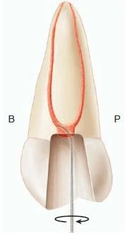 Giải phẫu ống tủy Dùng một cây trâm uốn cong ở đầu để thăm dò một miệng ống tủy hình oval