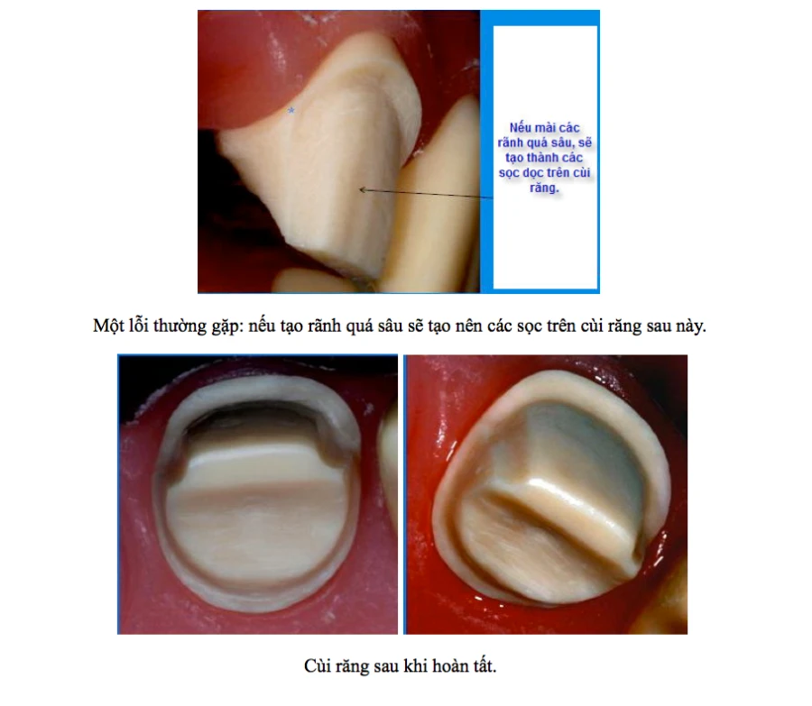 Những tiêu chí khi tiến hành cách mài cùi răng
