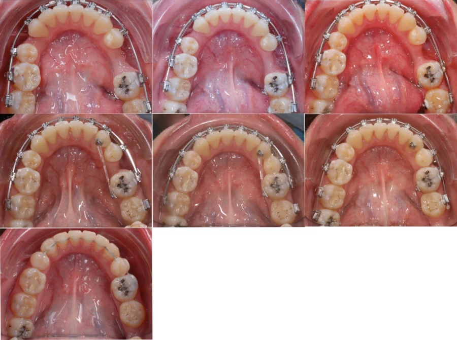 Sửa chữa vẩu hai hàm và đóng khoảng nhổ răng hàm nhỏ – kết quả