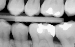 Xuất hiện thấu quang trên phim X-quang - liệu có phải là sâu răng? phim x-quang cánh cắn