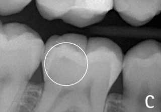Xuất hiện thấu quang trên phim X-quang - liệu có phải là sâu răng? phim x-quang cánh cắn 3