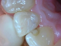 hiện tượng sâu răng