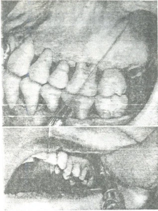 Kỹ thuật gây tê vùng khi nhổ răng gay-te-than-kinh-rang-tren-sau
