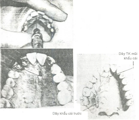 Kỹ thuật gây tê vùng khi nhổ răng vòm khẩu cùng răng cối