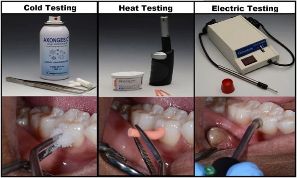 Các thử nghiệm : Thử nghiệm tủy răng 