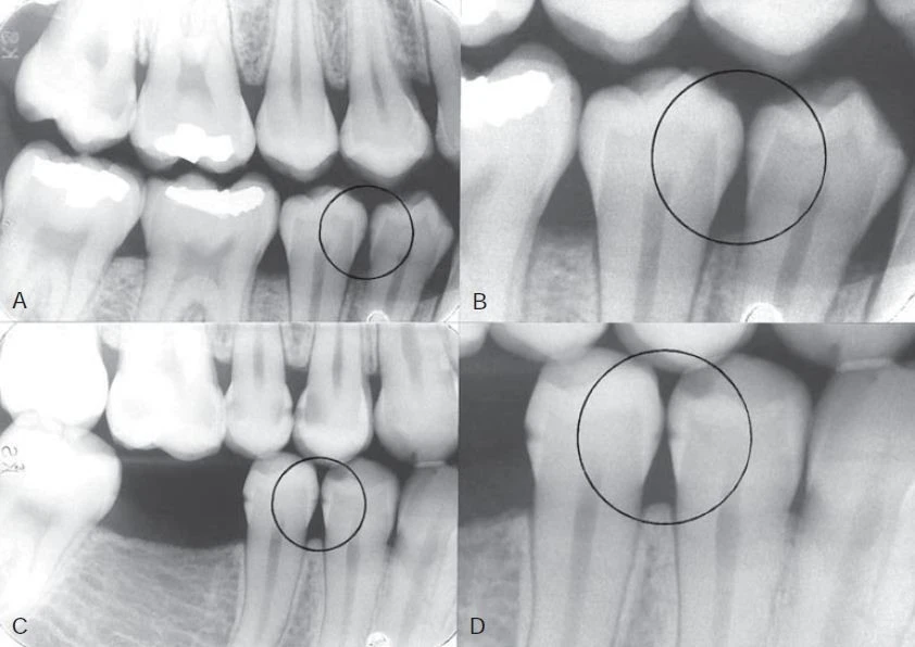 Hình ảnh phóng đại phát hiện sâu men vùng răng cối nhỏ
